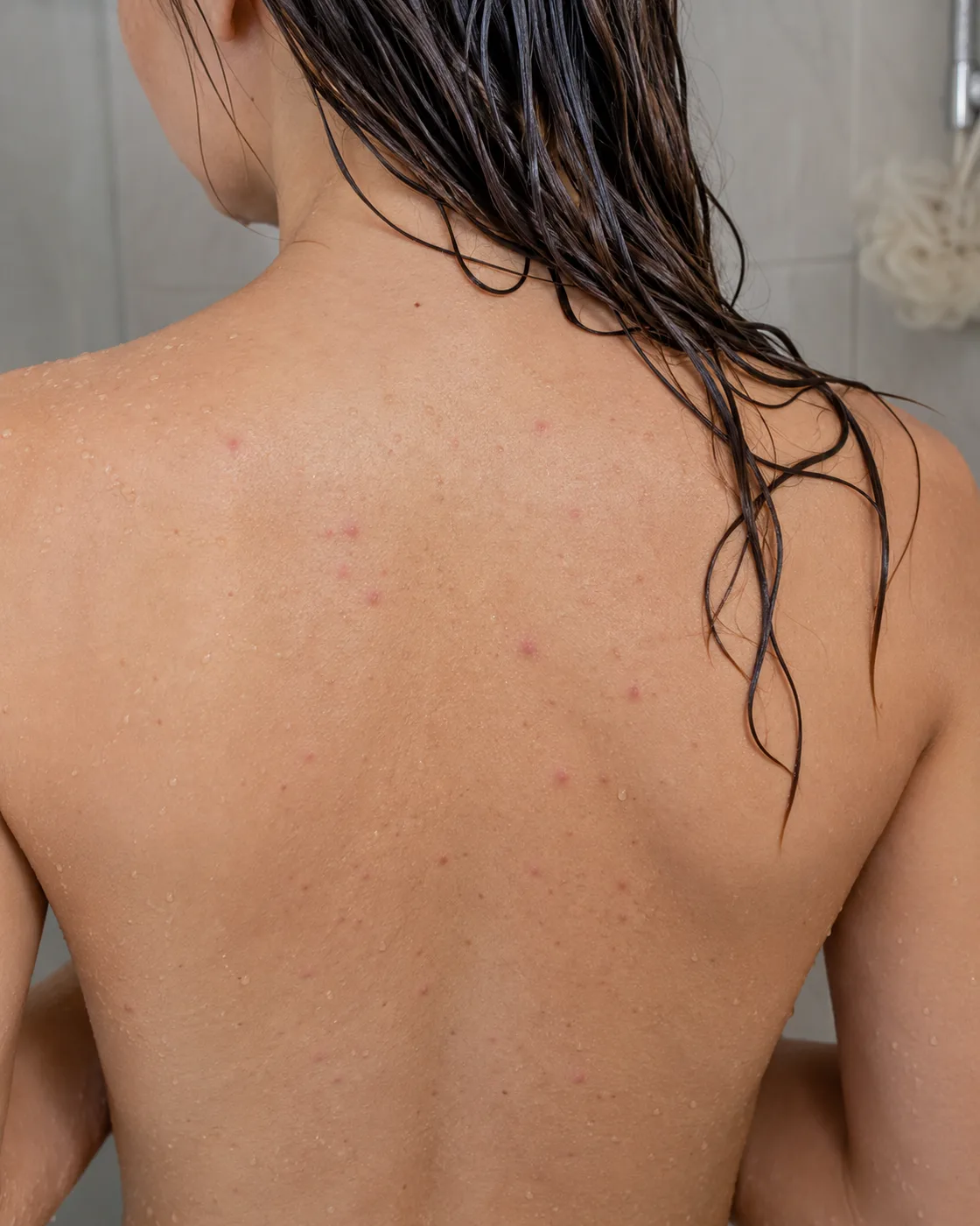 Back Acne from Conditioner