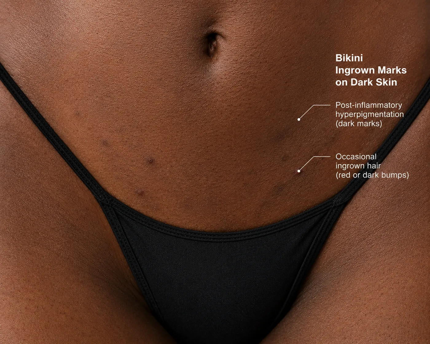 Bikini Ingrown Marks on Dark Skin