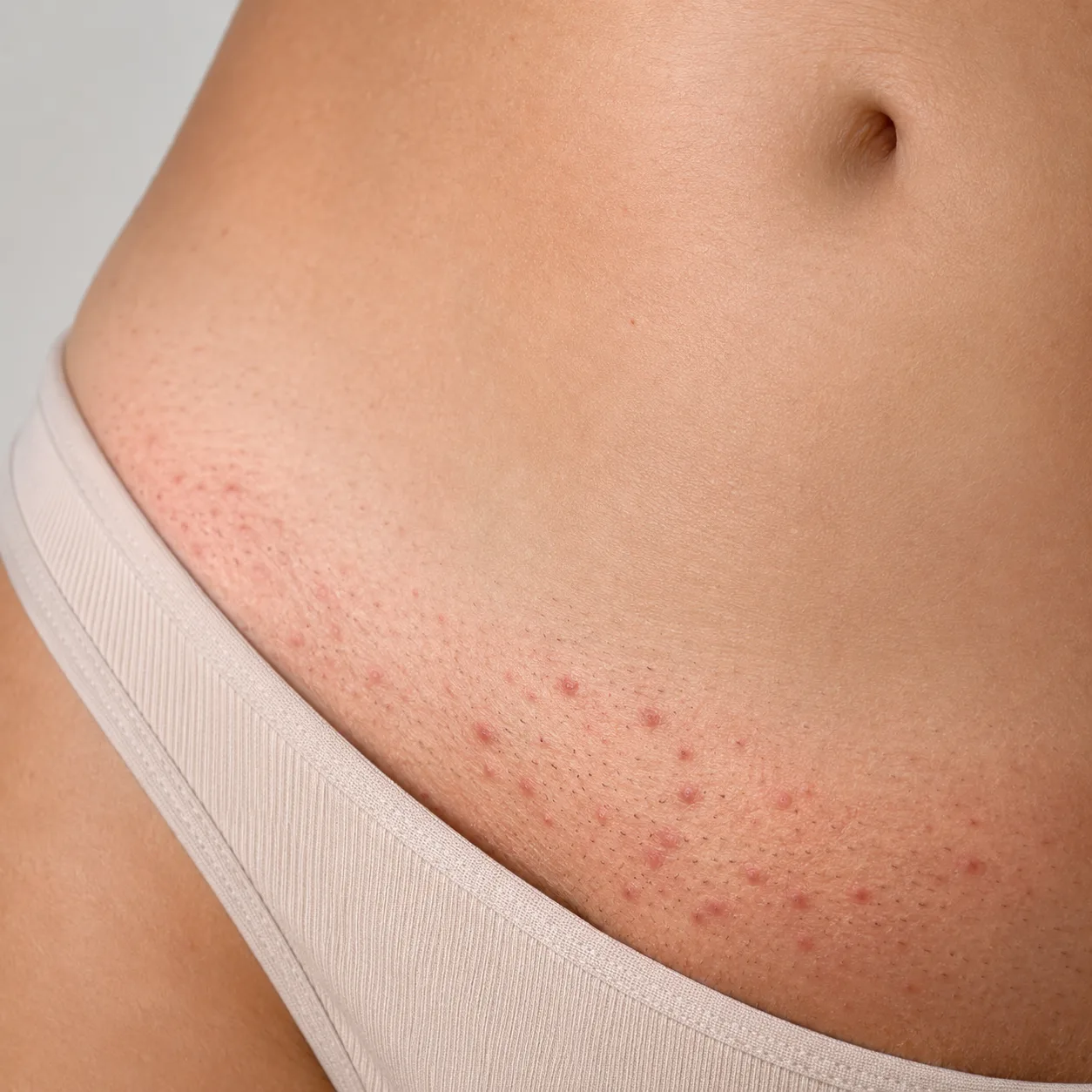 Razor Bumps on Bikini Line