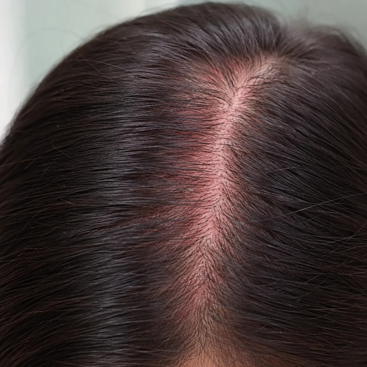 Scalp Itchy After Color